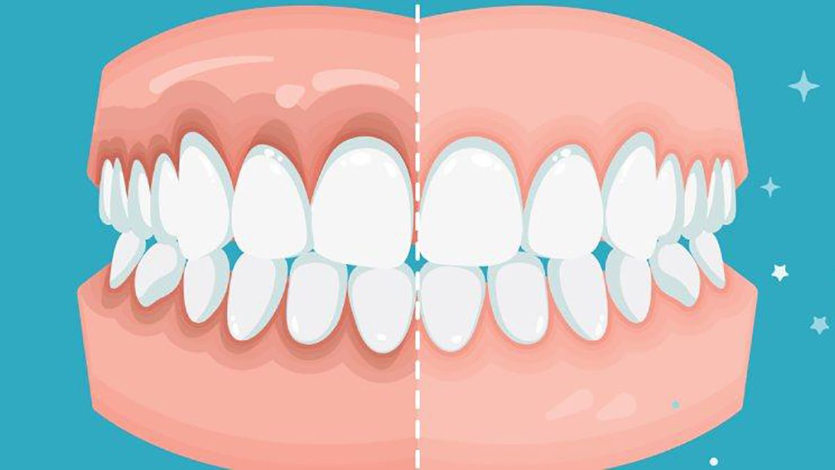 Enfermedades Periodontales C Mo Se Previenen Y Tratan