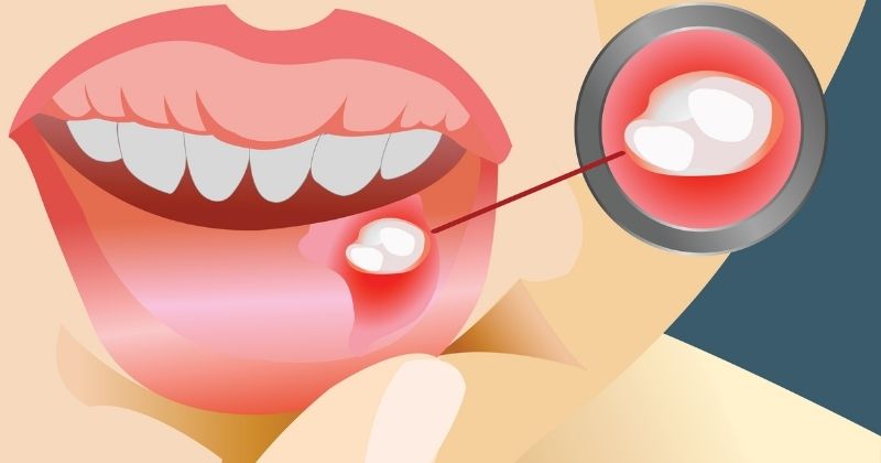 Por qué aparecen y como curar las llagas en la boca