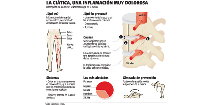 Ciática Síntomas Tratamientos E Información 6369