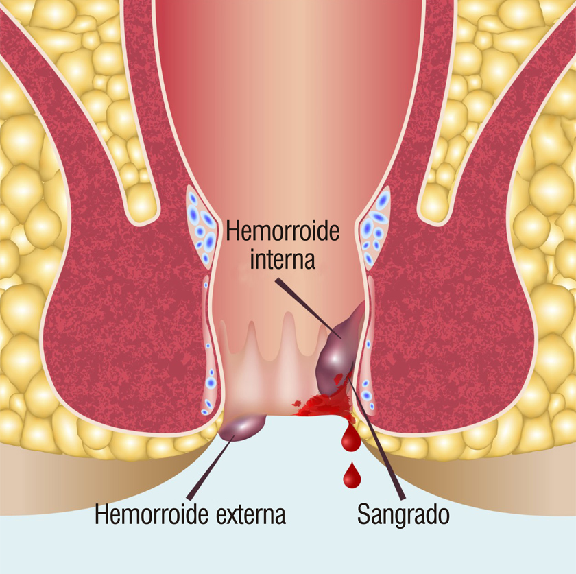 líquido Oso Molester Hemorroides: qué son, síntomas y tratamientos