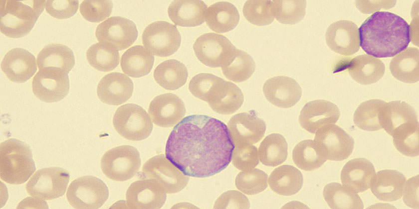 Imagen histológica de una leucemia linfoblástica aguda. 
